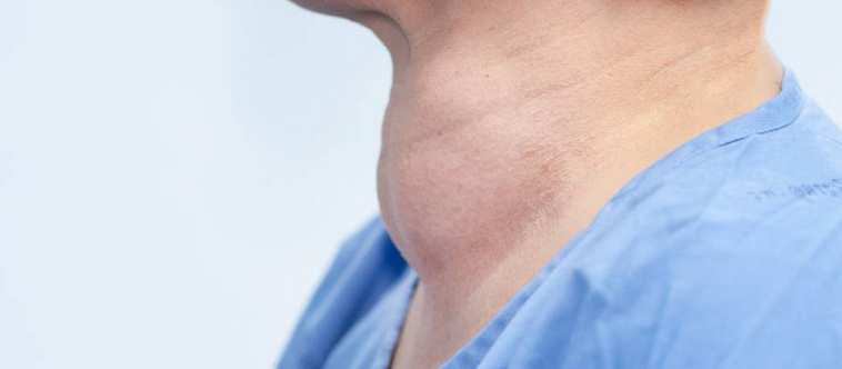 ما هي مضاعفات خمول الغدة الدرقية ؟